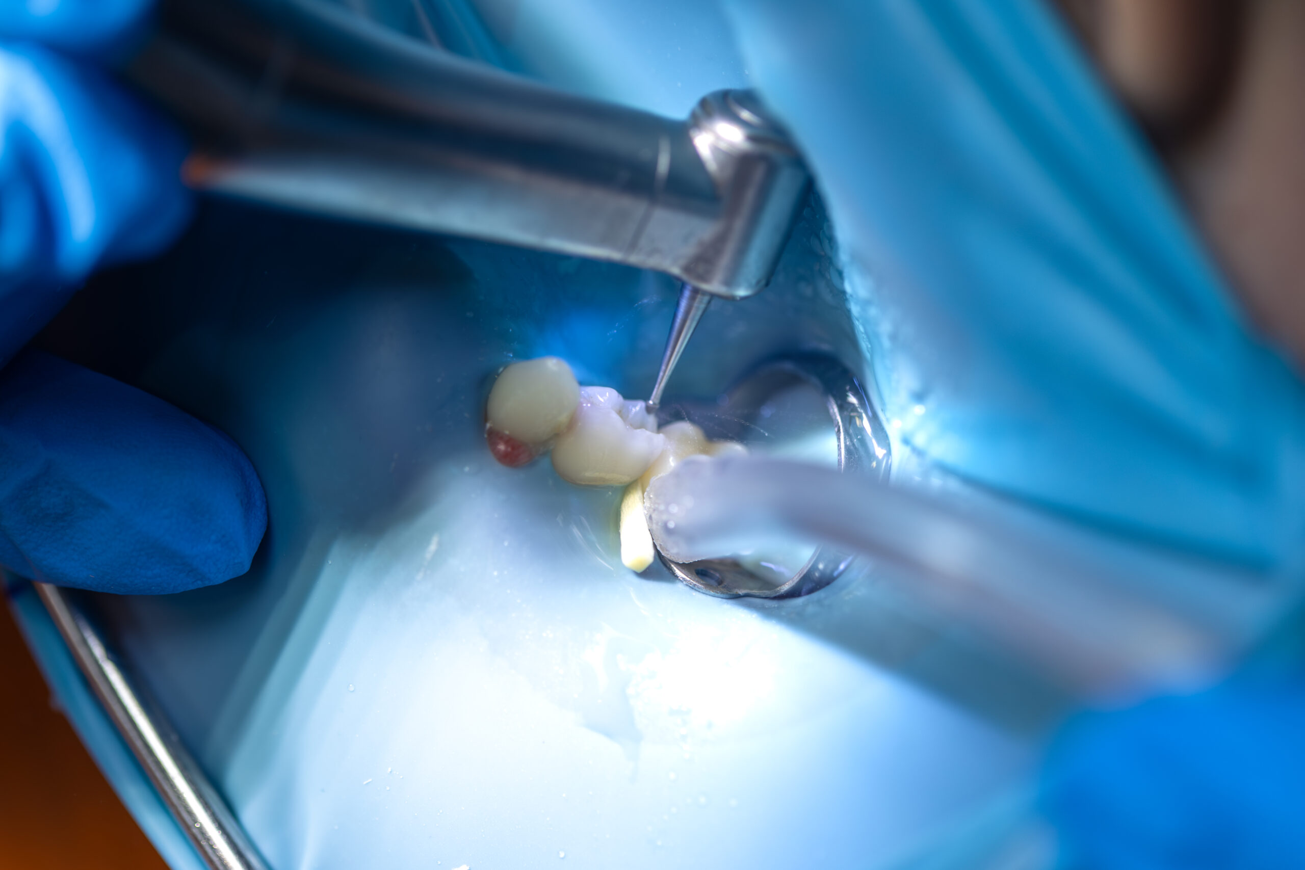 Cirugía oral - procedimientos quirúrgicos dentales