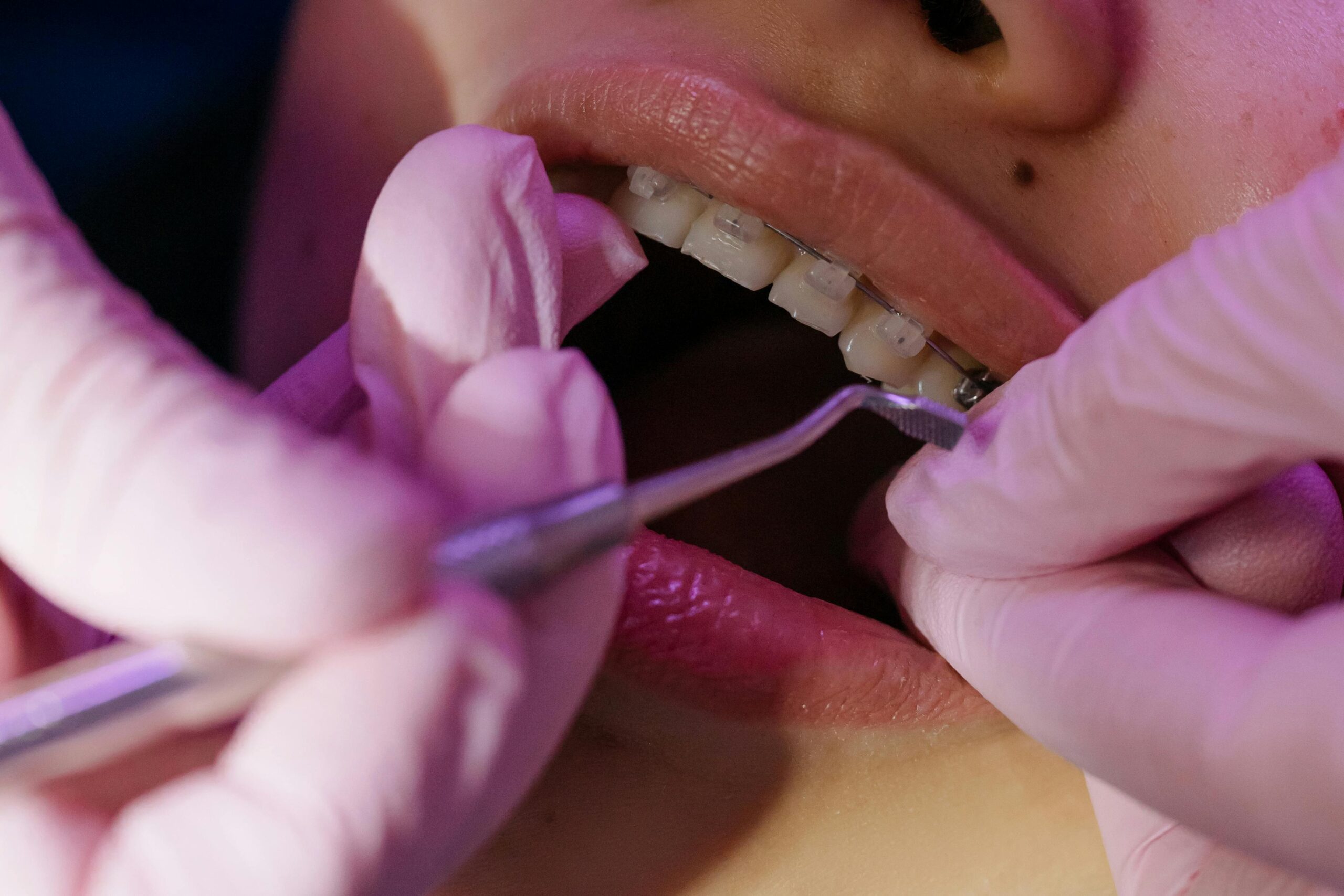Implantología dental - procedimiento de implantes